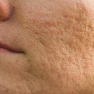 acne scarring on the cheek