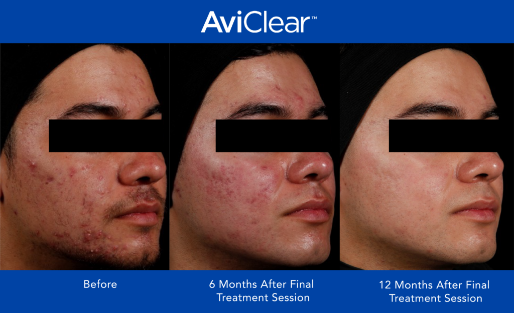 sequential images of a male patient before and after Aviclear treatment