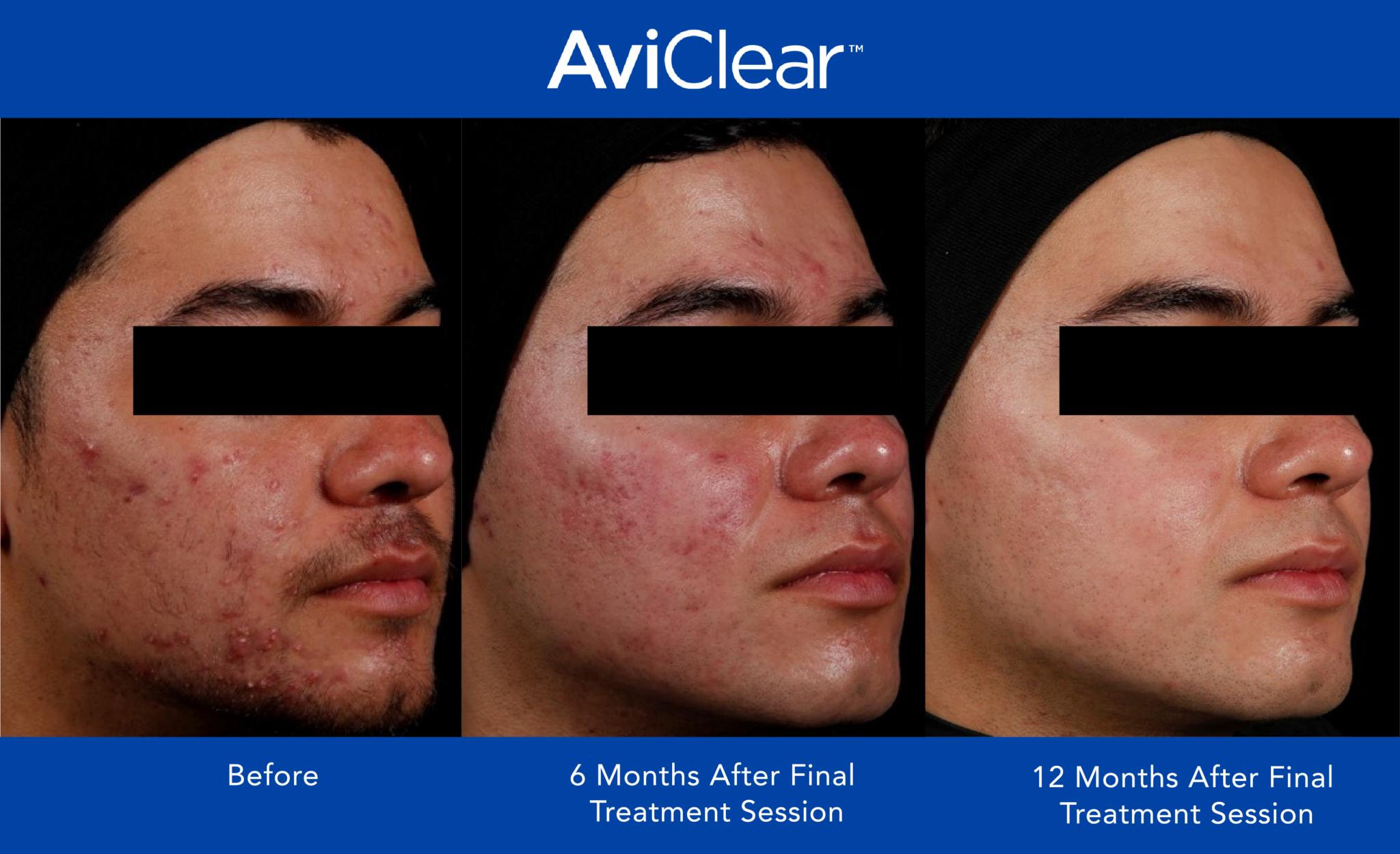 AviClear Perth | AviClear Laser for Acne | SkinBox East Fremantle