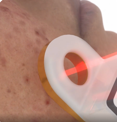 Aviclear laser being used on face with acne