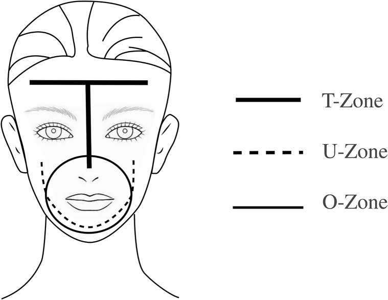 diagram showing the distinct acne patterns seen in the T zone of physiologic acne, the U zone of adult acne, and the O zone of maskne.
