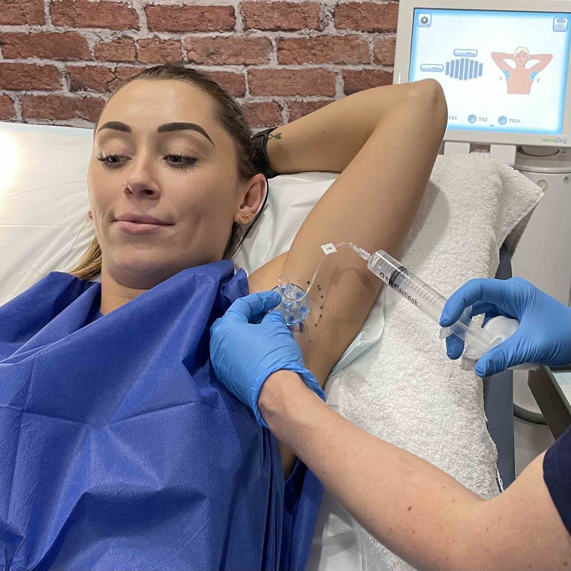 miraDry® explained what to expect SkinBox Clinics