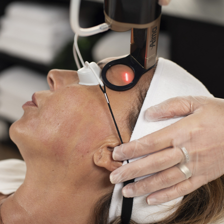 Patient wearing goggles undergoing a laser treatment to her face with Alma Hybrid laser