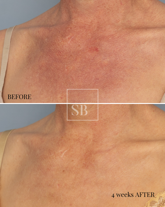 image of female décolletage area before and then 4 weeks after a single IPL treatment, showing clearance of blood vessels and excess pigmentation